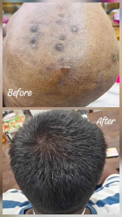 Bald scalp hair treatment before and after result