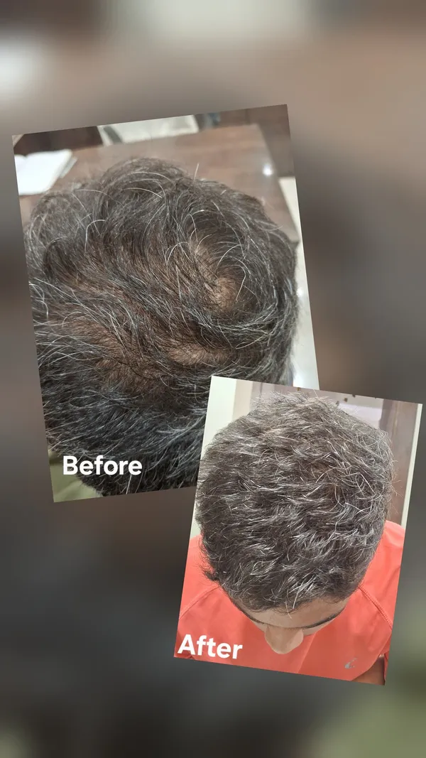 Before and after hair density treatment result