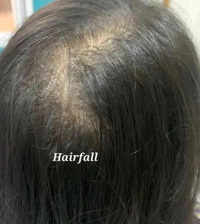 Hair Fall & Scalp Care at Sneha's Hair and Skin Clinic