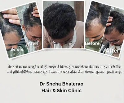 Dandruff Treatment at Sneha's Hair and Skin Clinic