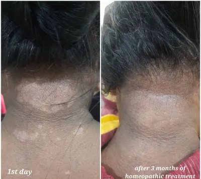 Skin Allergy & Sensitivity at Sneha's Hair and Skin Clinic