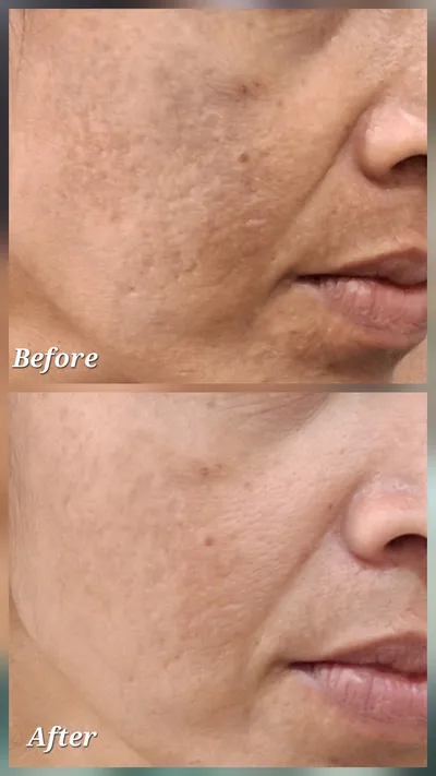 Pigmentation & Dark Spots at Sneha's Hair and Skin Clinic