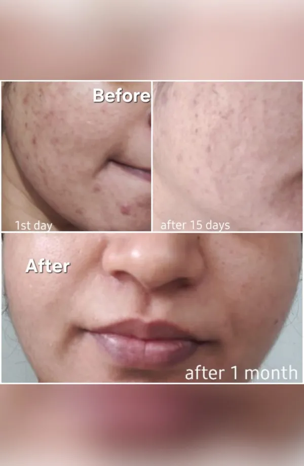 Skin treatment result